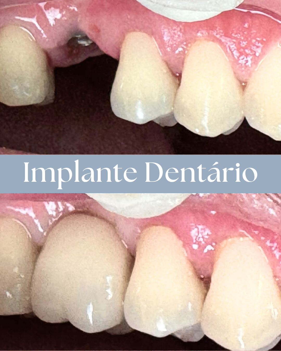 Resultado de tratamento odontológico realizado pela Dra. Priscylla Cafrune