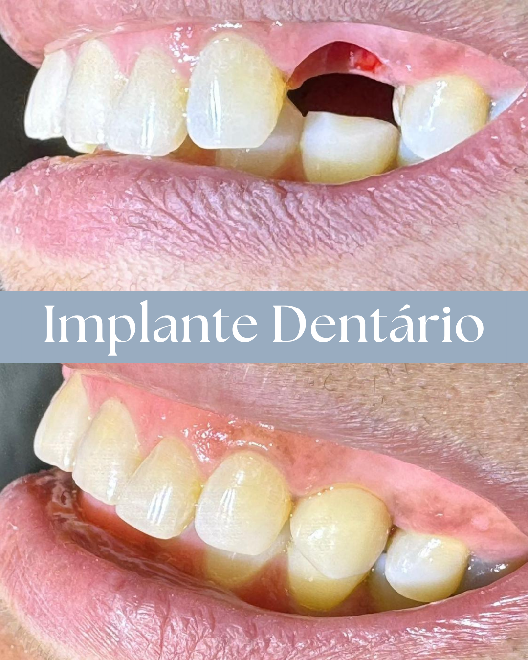 Resultado de tratamento odontológico realizado pela Dra. Priscylla Cafrune