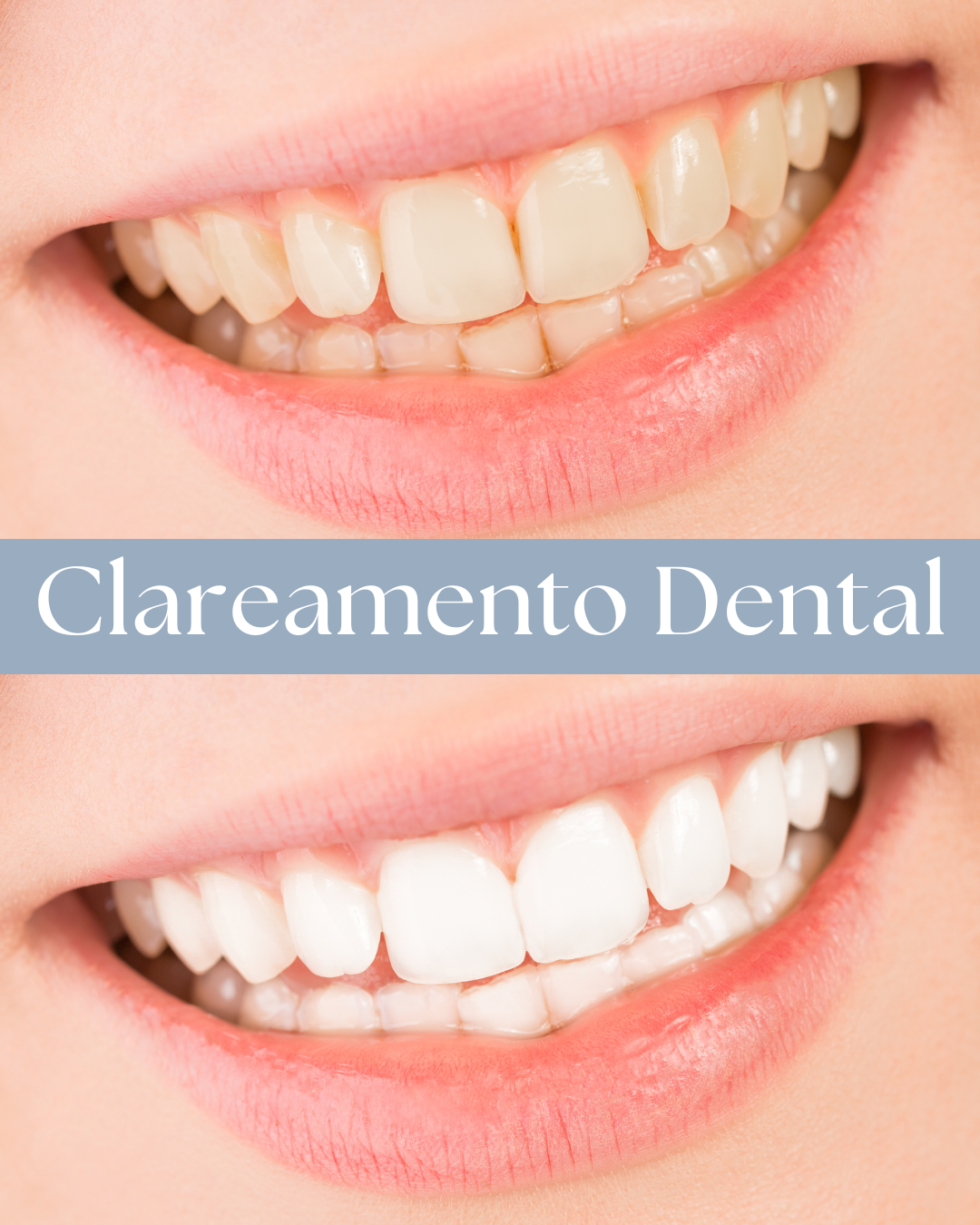 Resultado de tratamento odontológico realizado pela Dra. Priscylla Cafrune
