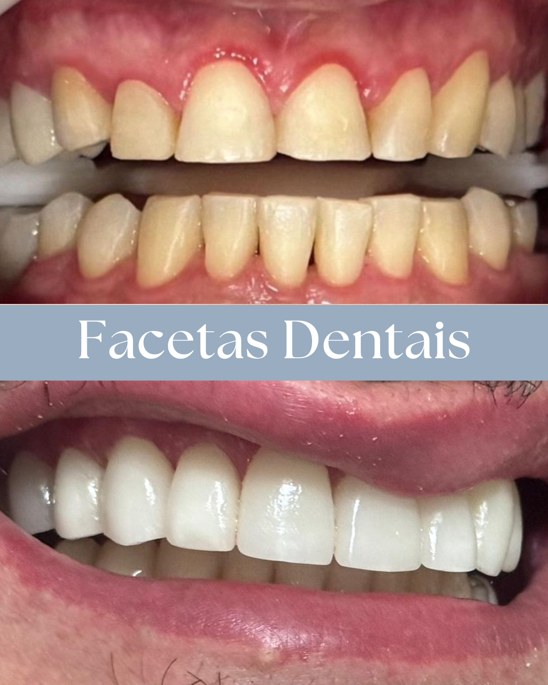 Resultado de tratamento odontológico realizado pela Dra. Priscylla Cafrune