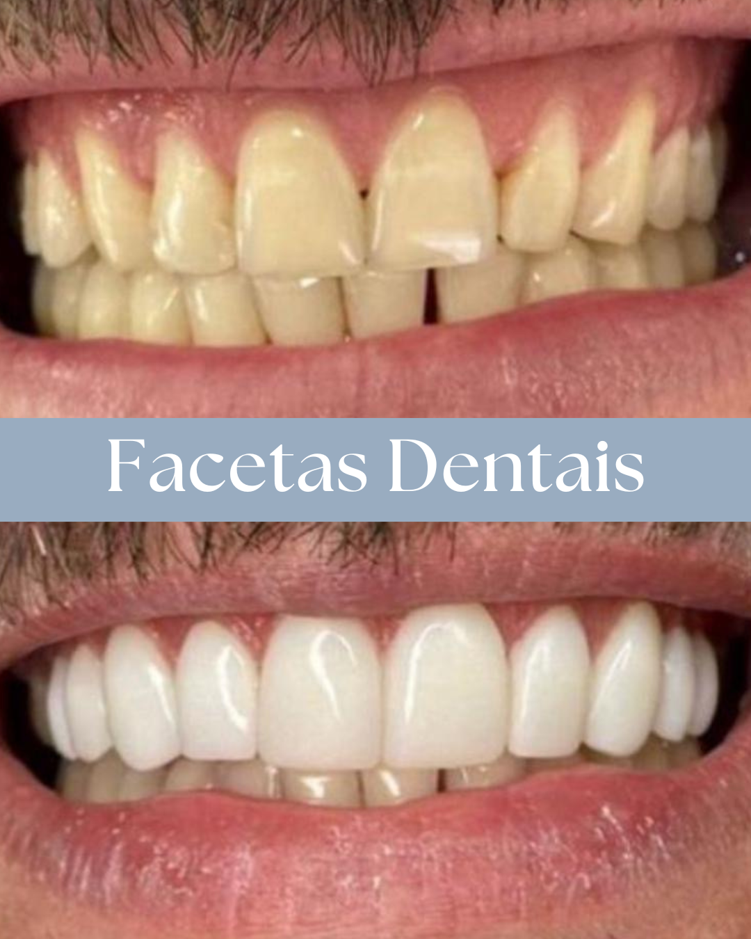 Resultado de tratamento odontológico realizado pela Dra. Priscylla Cafrune