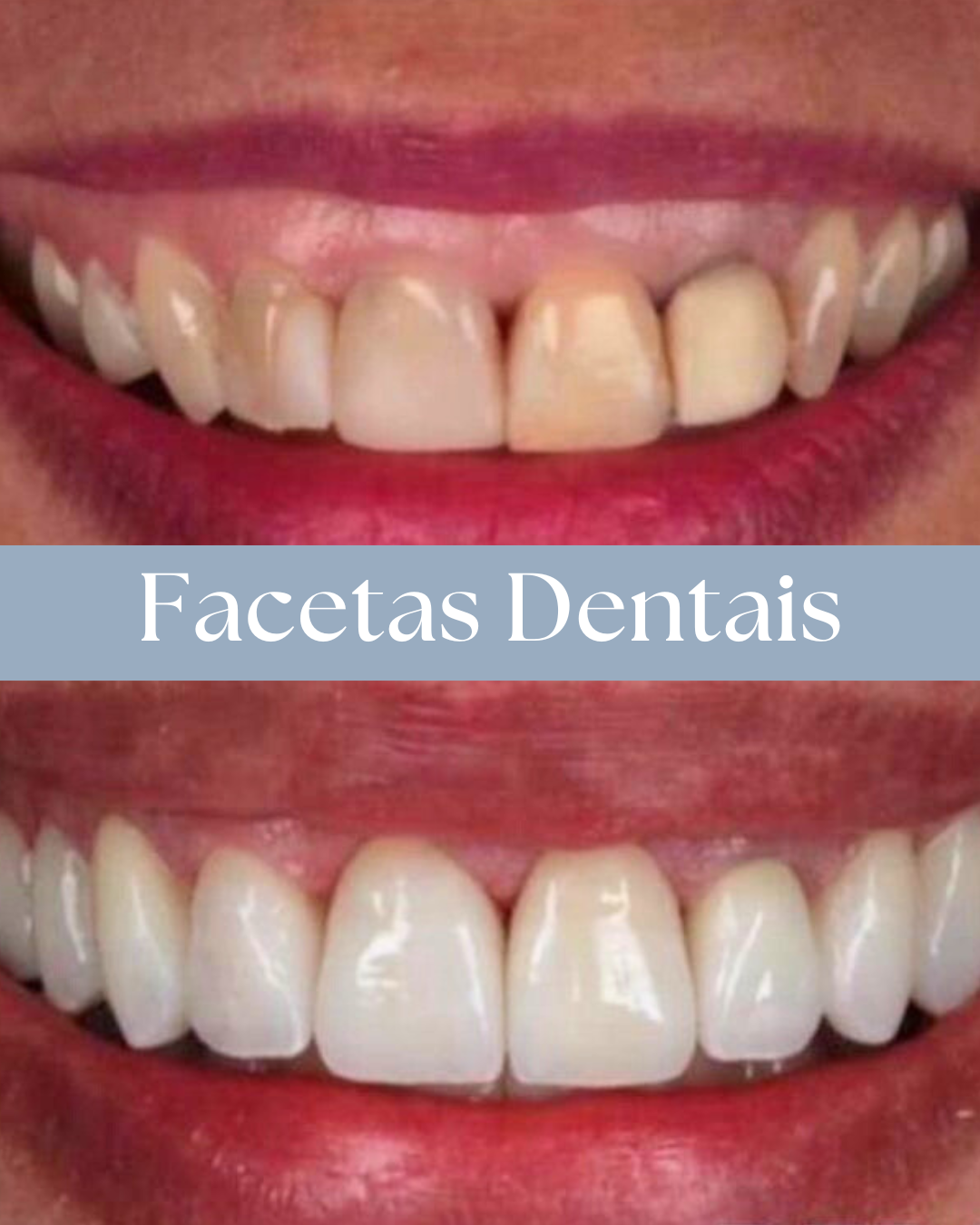 Resultado de tratamento odontológico realizado pela Dra. Priscylla Cafrune
