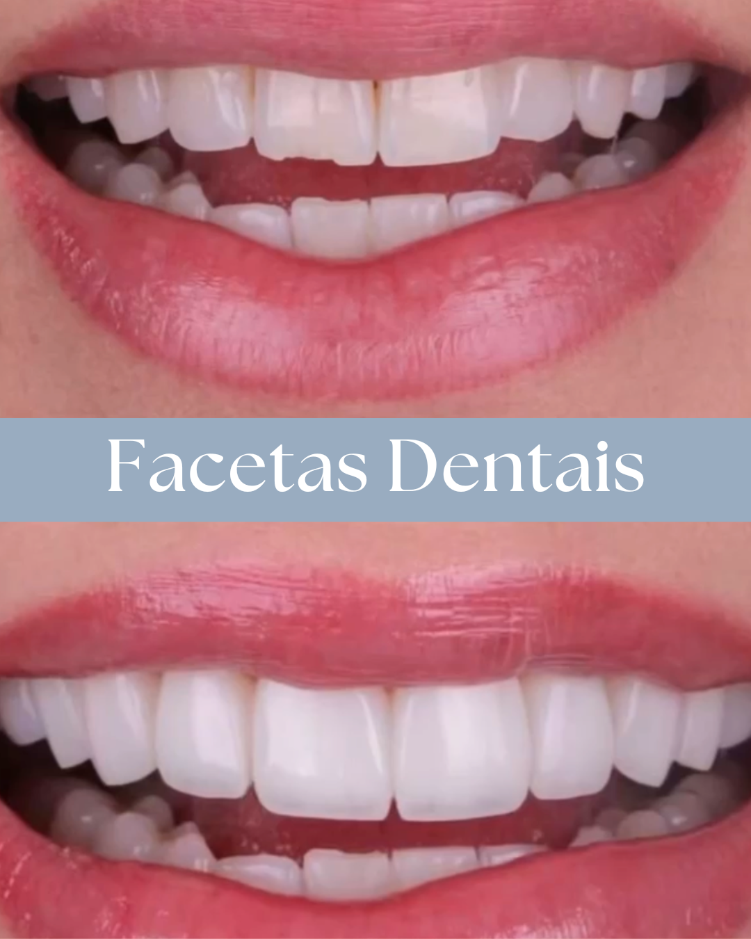 Resultado de tratamento odontológico realizado pela Dra. Priscylla Cafrune