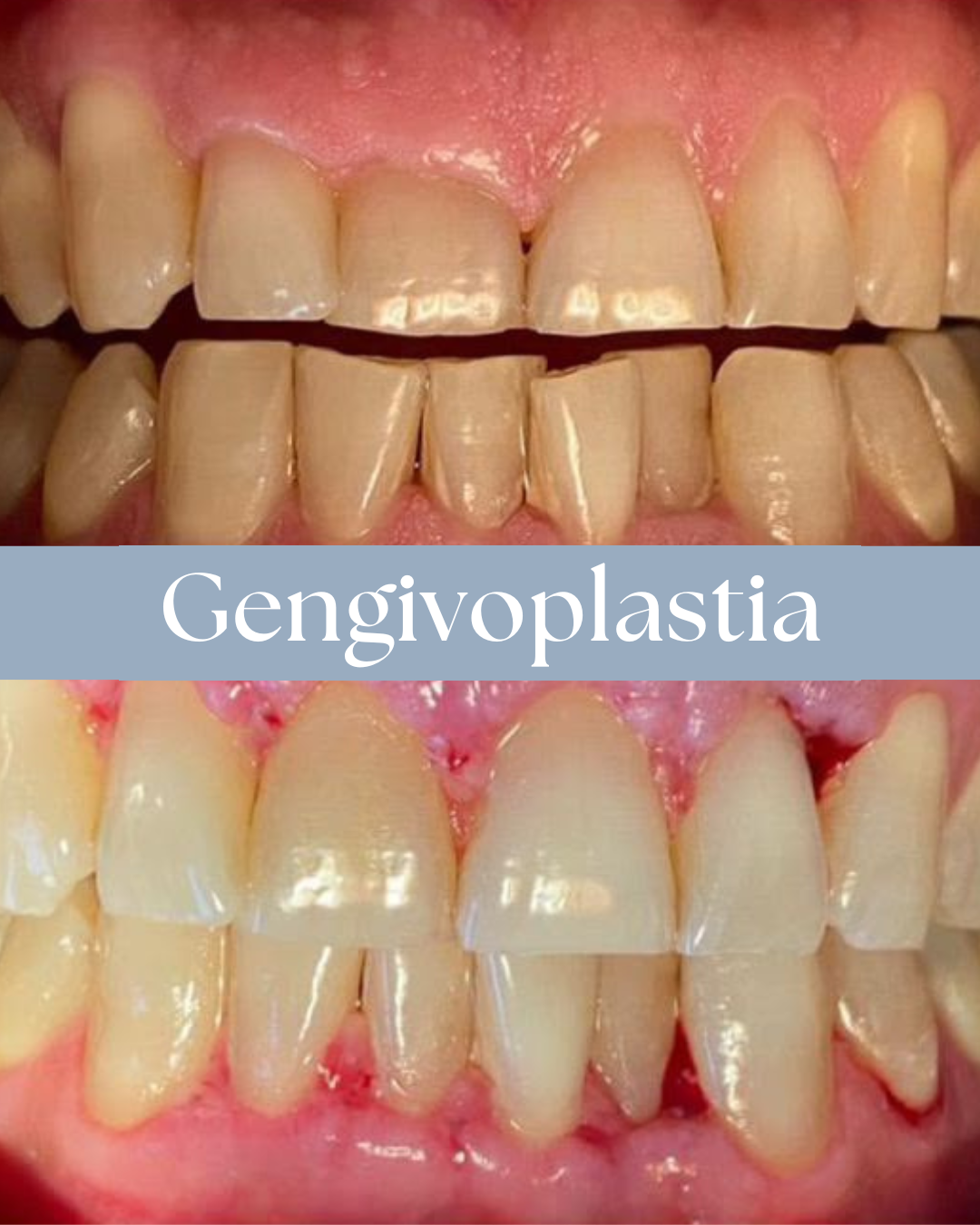 Resultado de tratamento odontológico realizado pela Dra. Priscylla Cafrune