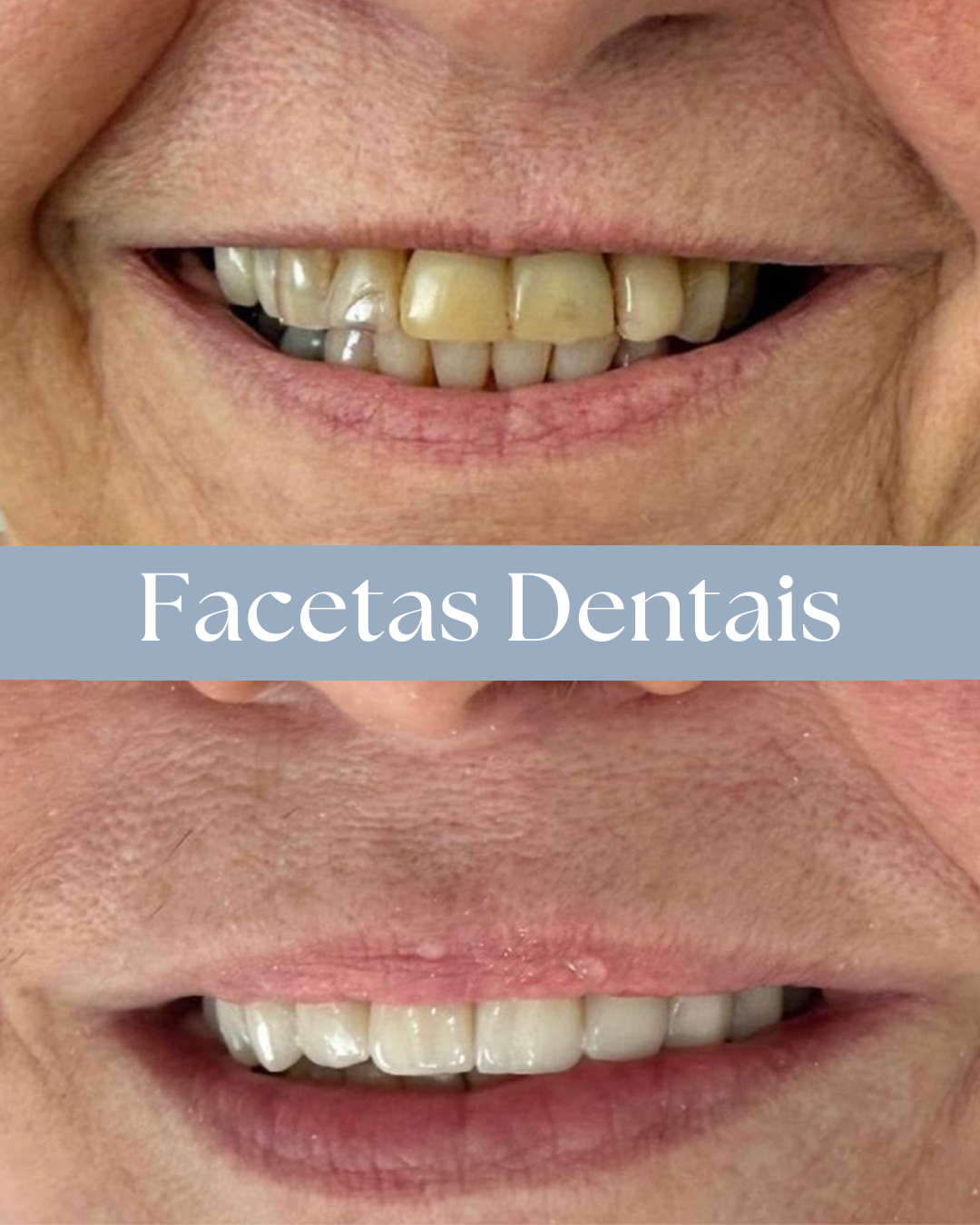 Resultado de tratamento odontológico realizado pela Dra. Priscylla Cafrune