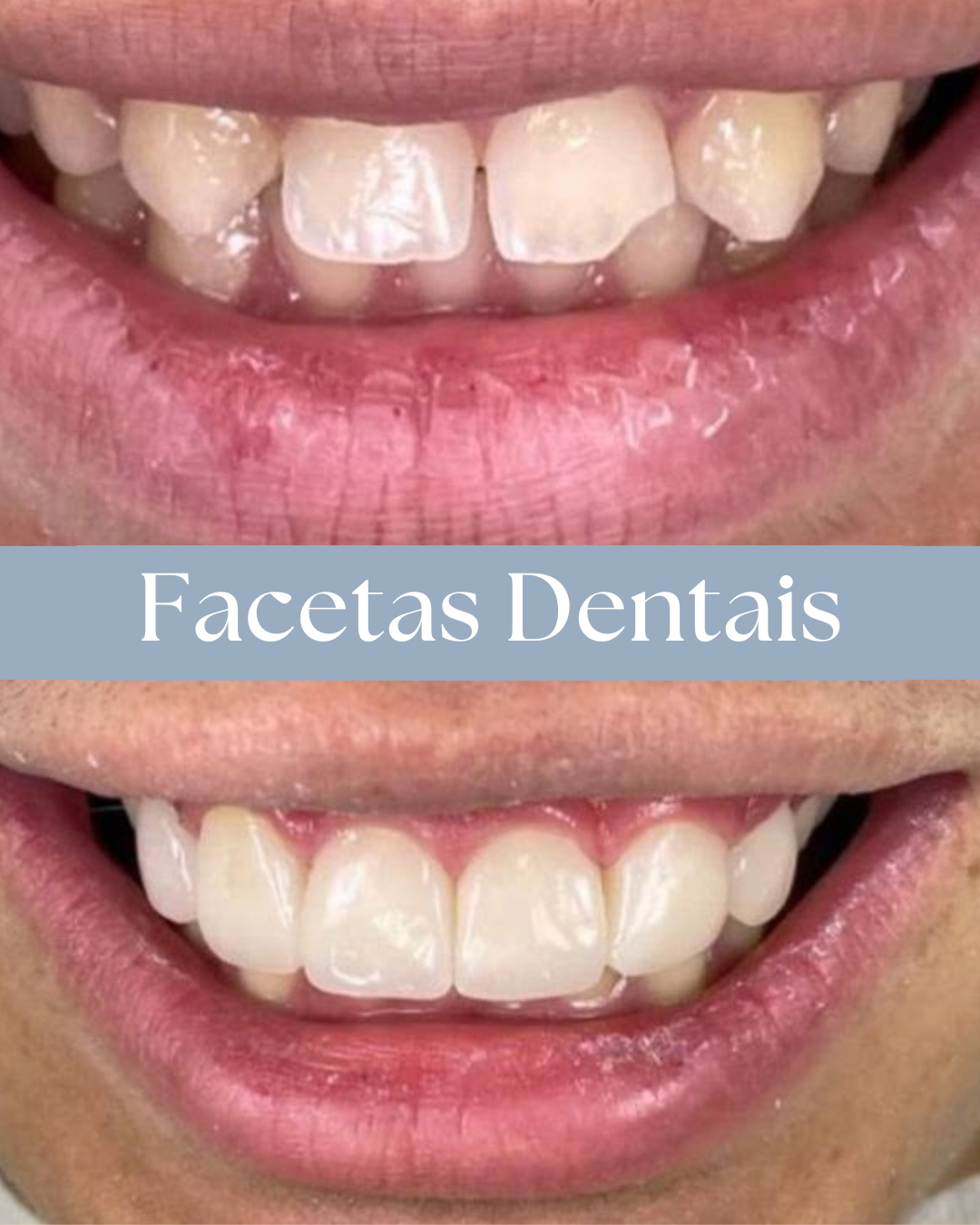 Resultado de tratamento odontológico realizado pela Dra. Priscylla Cafrune
