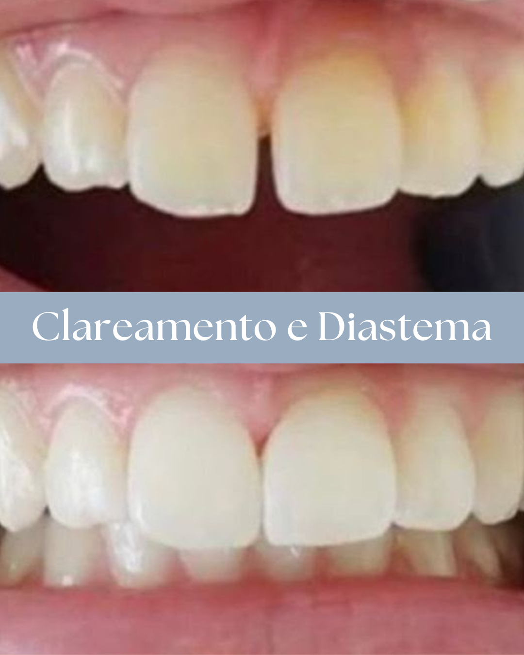 Resultado de tratamento odontológico realizado pela Dra. Priscylla Cafrune