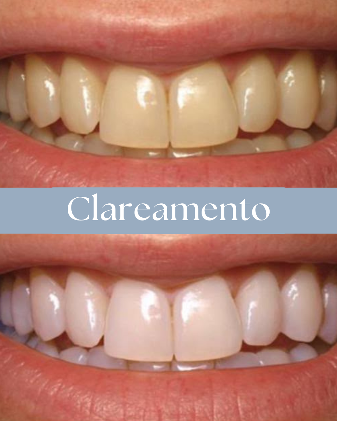 Resultado de tratamento odontológico realizado pela Dra. Priscylla Cafrune