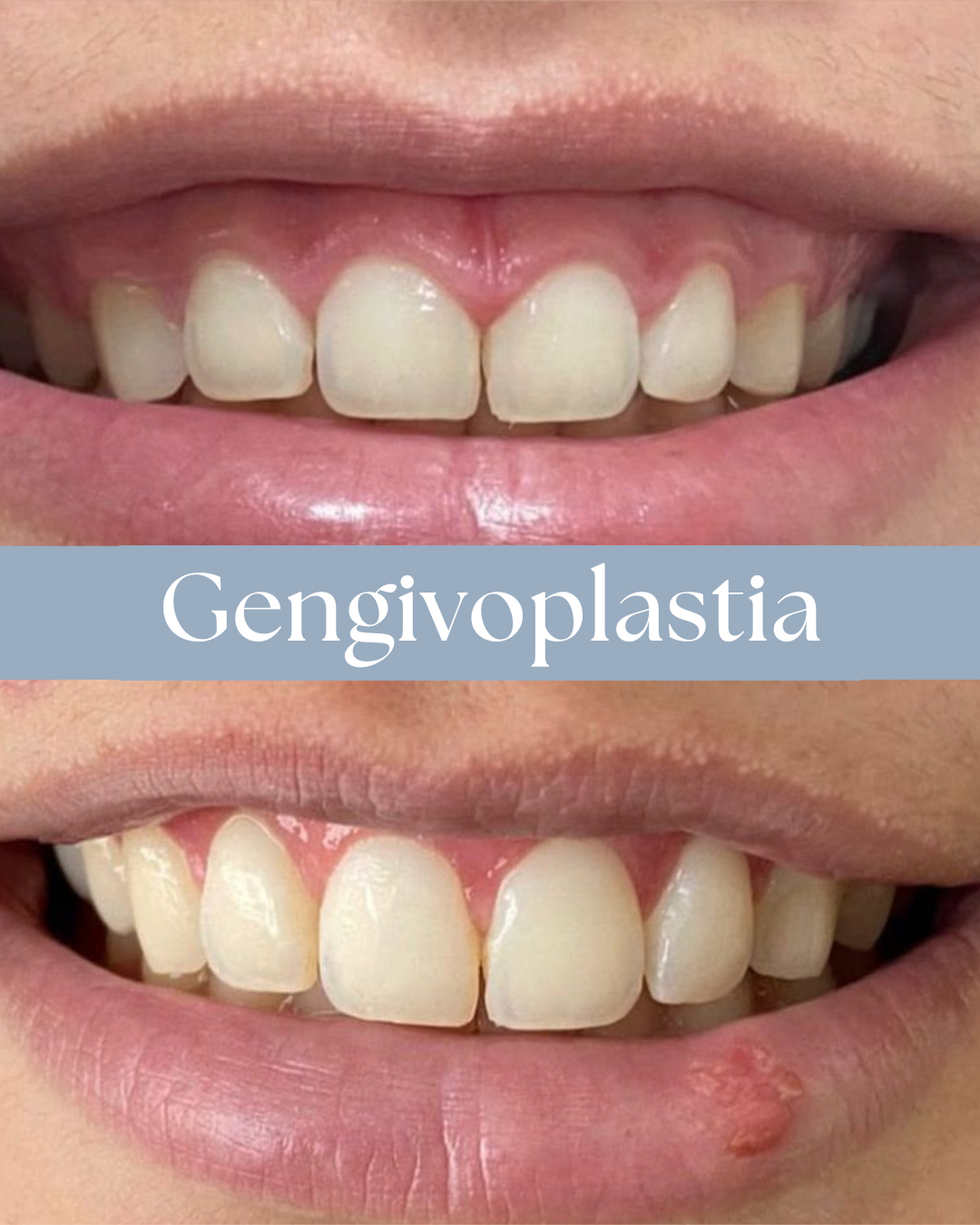 Resultado de tratamento odontológico realizado pela Dra. Priscylla Cafrune
