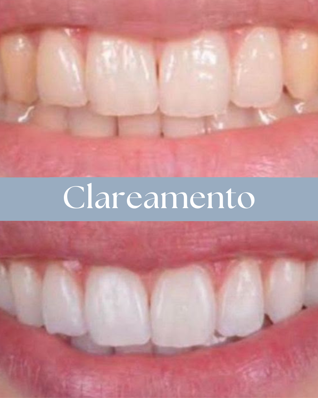 Resultado de tratamento odontológico realizado pela Dra. Priscylla Cafrune
