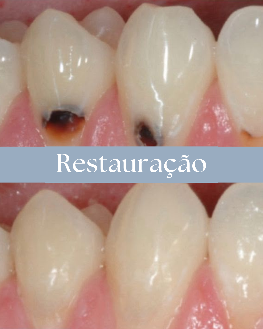 Resultado de tratamento odontológico realizado pela Dra. Priscylla Cafrune