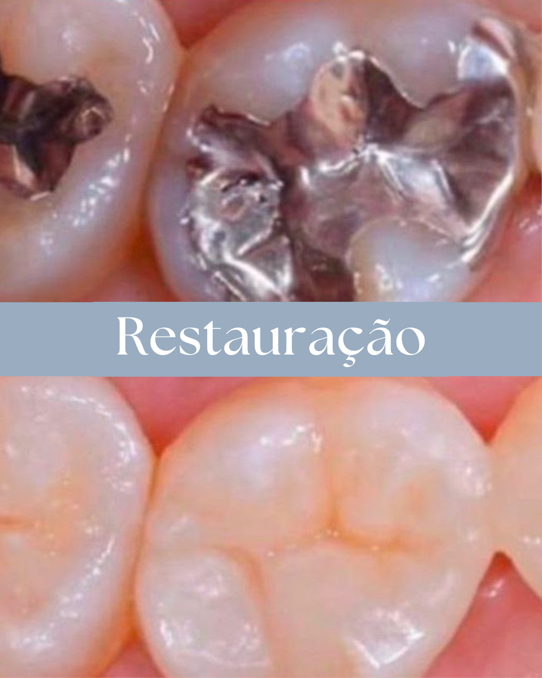 Resultado de tratamento odontológico realizado pela Dra. Priscylla Cafrune