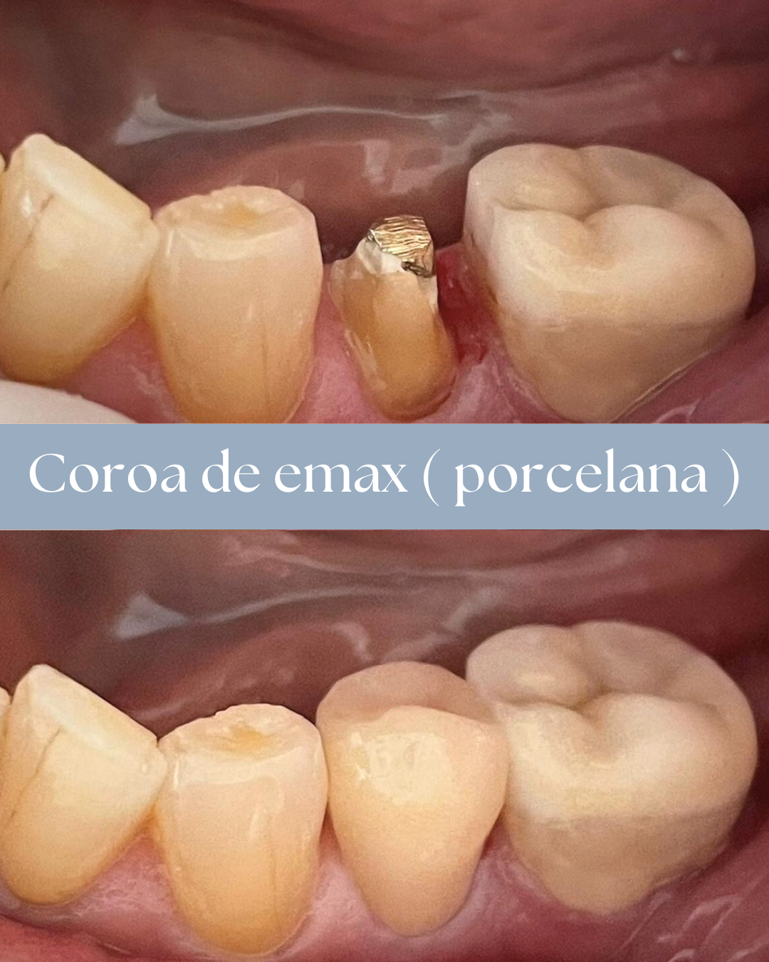 Resultado de tratamento odontológico realizado pela Dra. Priscylla Cafrune