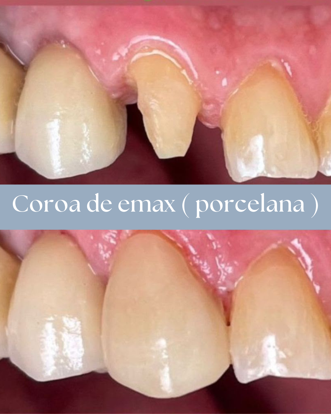 Resultado de tratamento odontológico realizado pela Dra. Priscylla Cafrune