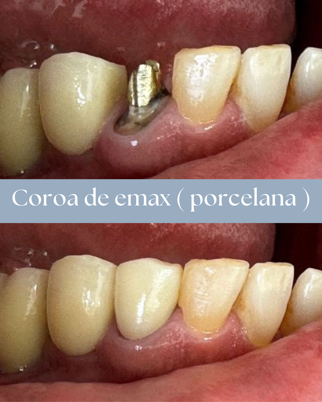 Resultado de tratamento odontológico realizado pela Dra. Priscylla Cafrune