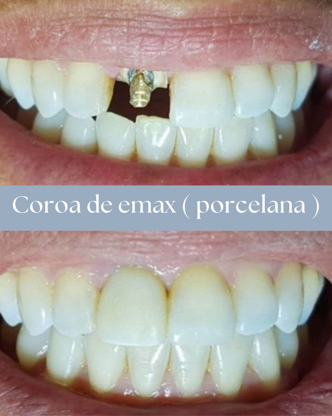 Resultado de tratamento odontológico realizado pela Dra. Priscylla Cafrune
