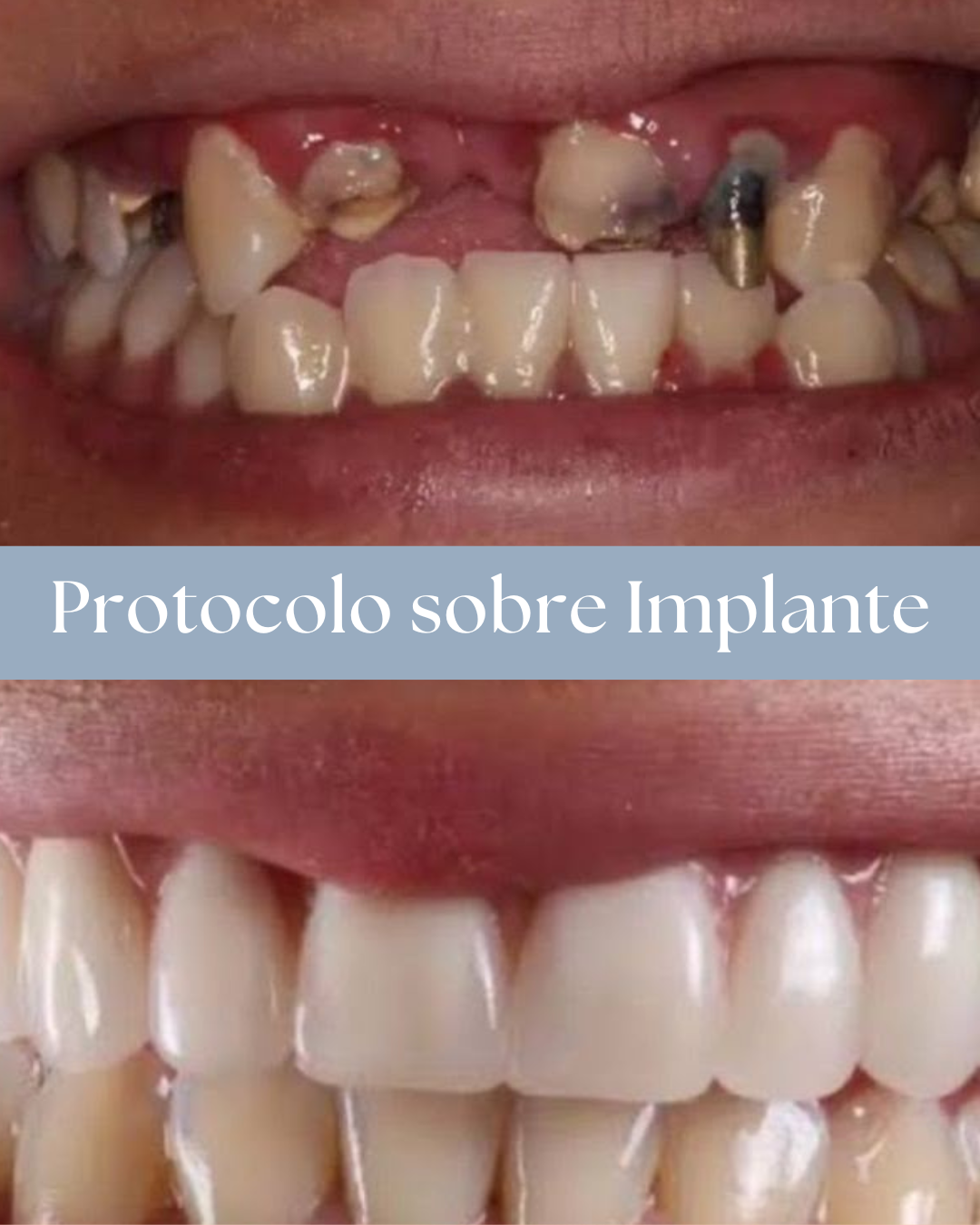 Resultado de tratamento odontológico realizado pela Dra. Priscylla Cafrune