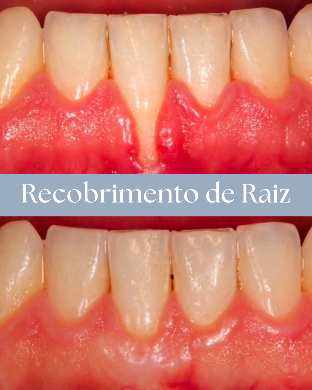 Resultado de tratamento odontológico realizado pela Dra. Priscylla Cafrune