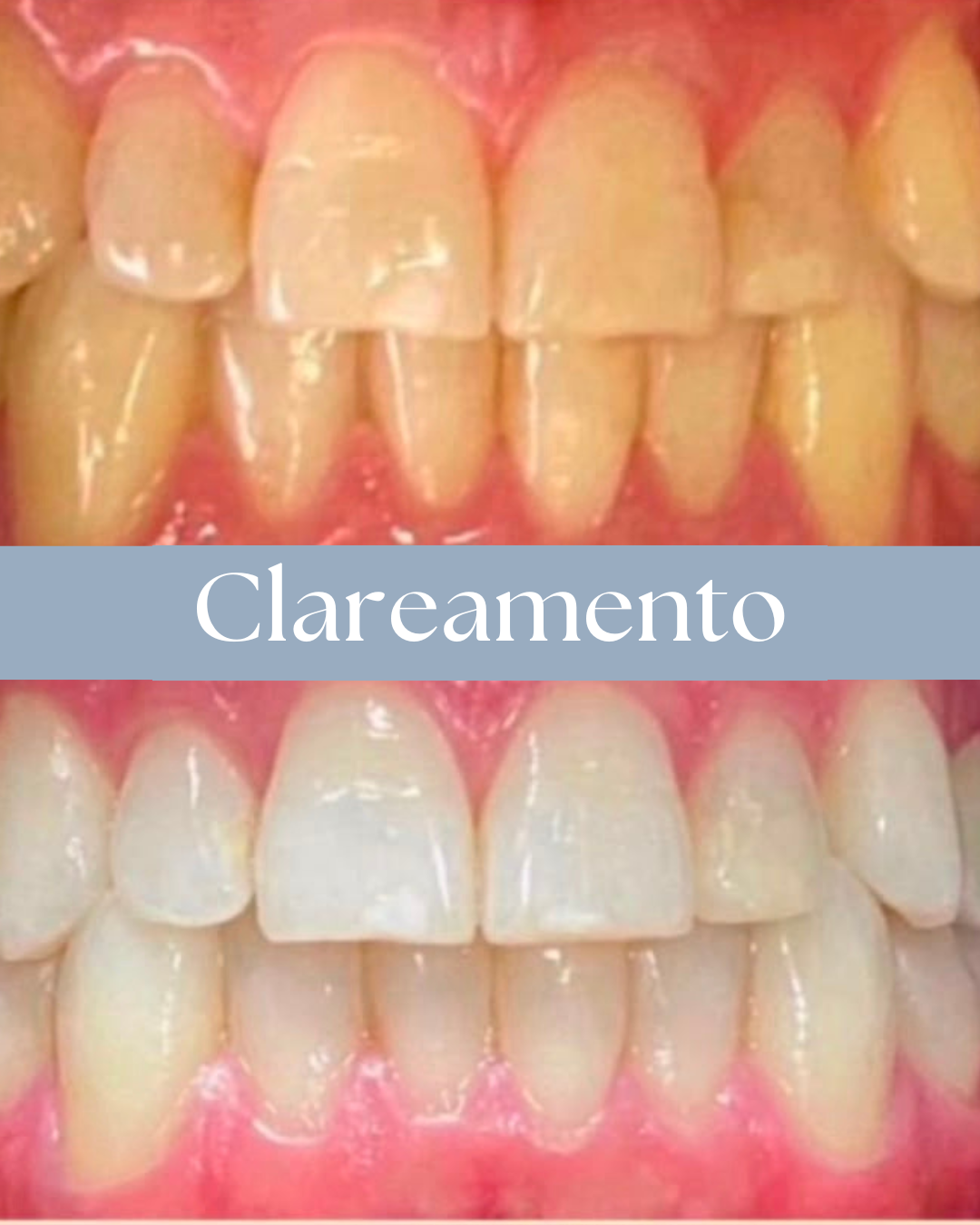 Resultado de tratamento odontológico realizado pela Dra. Priscylla Cafrune