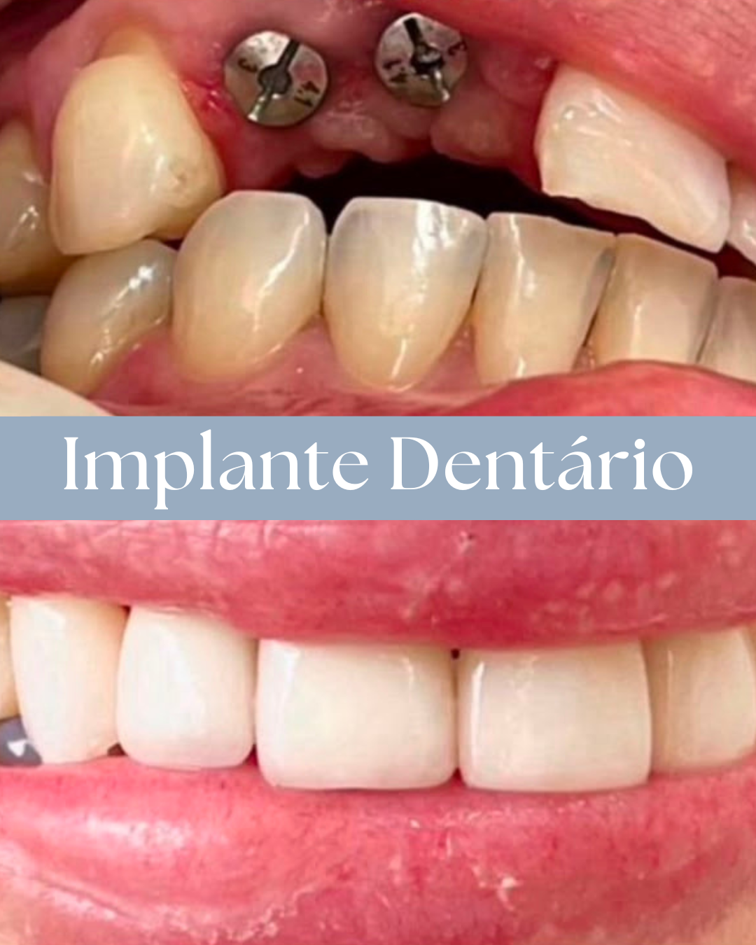 Resultado de tratamento odontológico realizado pela Dra. Priscylla Cafrune
